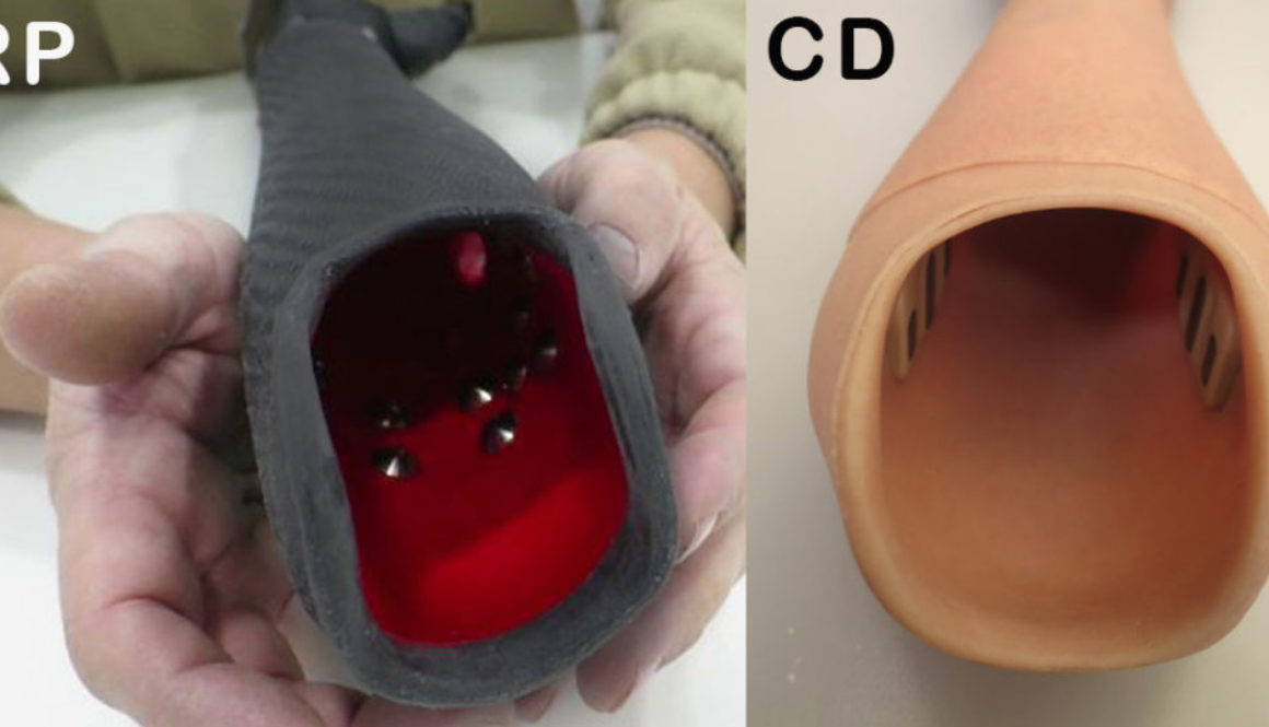 Electrodos interior del encaje de una prótesis con CD y otra RP
