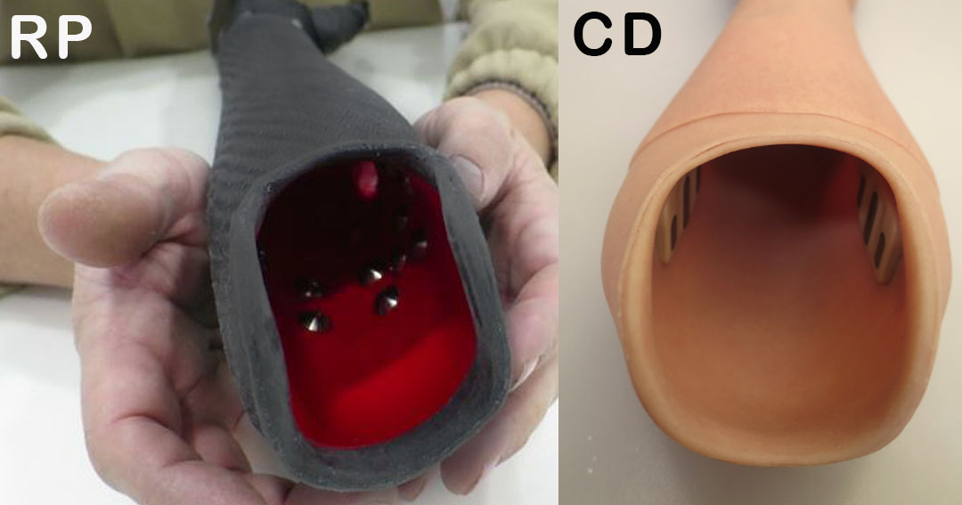 Electrodos interior del encaje de una prótesis con CD y otra RP